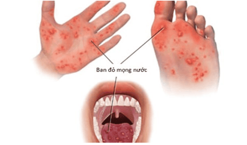 
Biểu hiện của bệnh chân tay miệng ở trẻ
