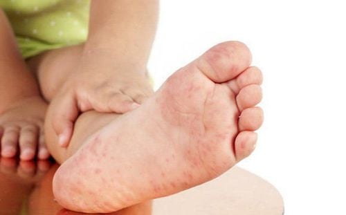 4 levels of hand, foot and mouth disease - grade 1 need to go to the hospital?