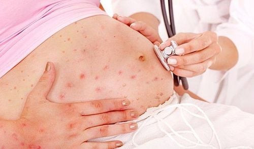 
Hình ảnh triệu chứng sốt Rubella khi mang thai, là loại sốt virus nguy hiểm dễ gây ra dị tật cho thai nhi
