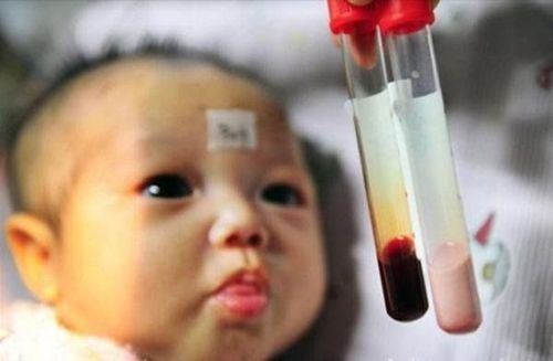 
Trẻ Thalassemia mức độ nặng bị thiếu máu nặng
