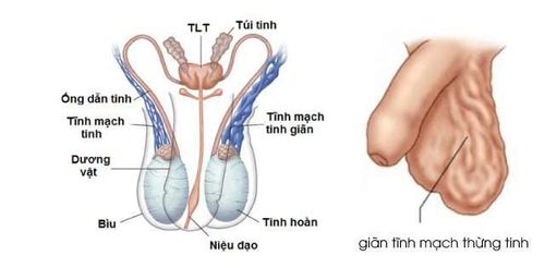 
Giãn tĩnh mạch thừng tinh là một bệnh lý phổ biến ở nam giới
