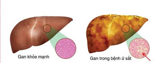 
Tình trạng ứ sắt gây tổn thương gan

