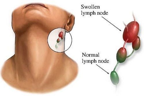 
Sưng hạch bạch huyết có thể là dấu hiệu của nhiễm HIV cấp tính
