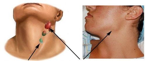 What is the difference between lymph node tuberculosis and pulmonary tuberculosis?