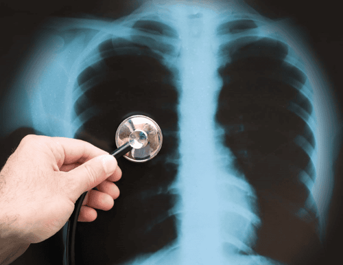 Diseases that can be diagnosed early with a chest X-ray