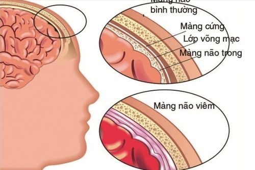 
Viêm xoang có thể dẫn đến biến chứng viêm màng não vô cùng nguy hiểm
