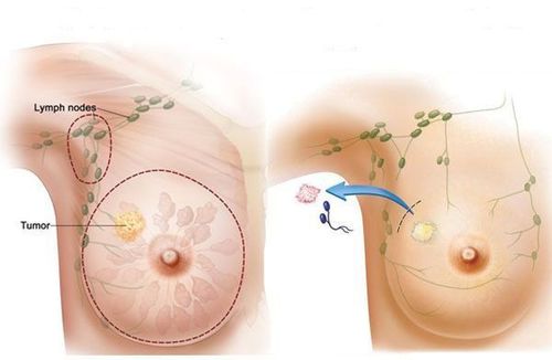 
Có thể lựa chọn phẫu thuật bảo tồn tuyến vú hay cắt toàn bộ tuyến vú phù hợp
