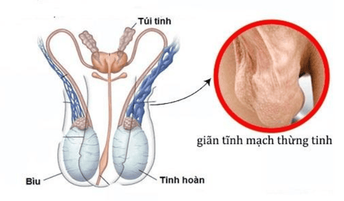 
Hình ảnh giãn tĩnh mạch thừng tinh
