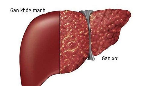 
Tình trạng máu đông chậm hơn có thể gặp ở đối tượng bệnh nhân xơ gan
