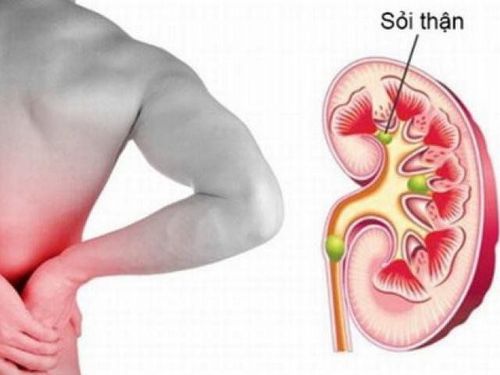 
Theo thống kê, cứ 10 người thì có 1 người bị sỏi thận trong quá trình sinh sống
