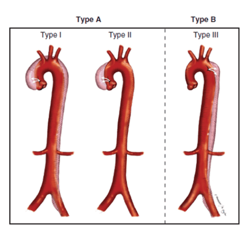 
Lóc tách động mạch chủ type A và type B
