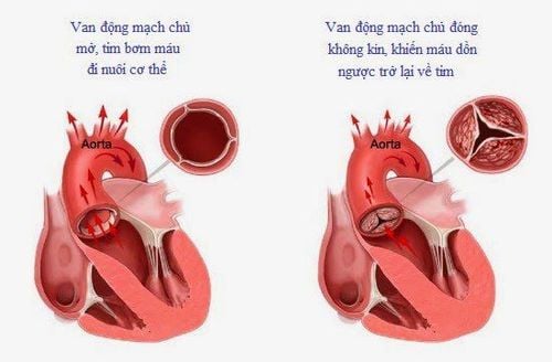 
Hẹp van động mạch chủ
