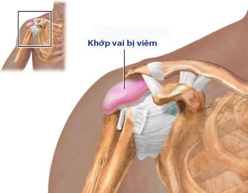 
Hình ảnh khớp vai bị viêm
