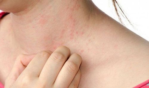 
Những triệu chứng đầu tiên của bệnh HIV là phát ban đỏ ở da
