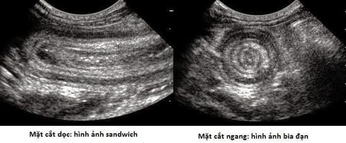 
Hình ảnh siêu âm lồng ruột
