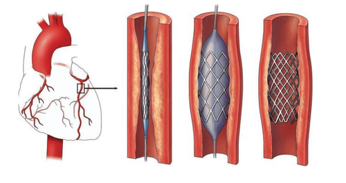 Development of coronary stents