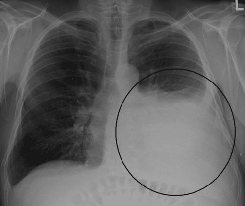 
Image of pleural effusion on X-ray film
