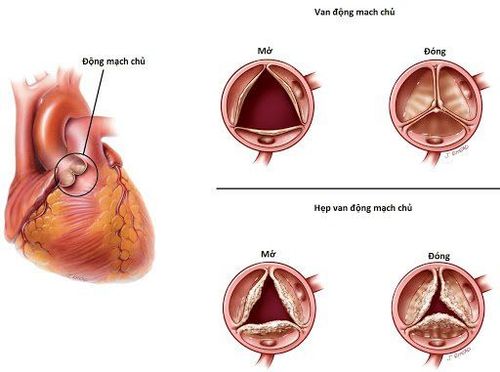 
Hở van tim là biến chứng muộn của kênh nhĩ thất gây ra
