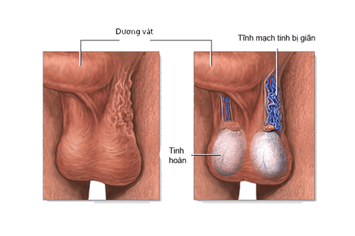 
ĩnh mạch ở bìu bị thắt lại và giãn ra dẫn tới đau và căng tức kéo dài ở vùng dưới
