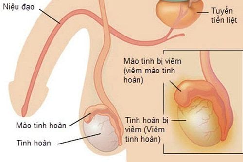 
Nếu bạn cảm thấy tinh hoàn mềm và sưng viêm, có thể là do các ống mào tinh trong tinh hoàn bị nhiễm một loại vi khuẩn hoặc virus
