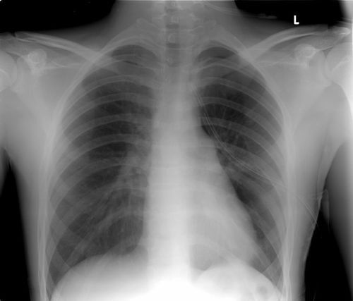 Diagnostic test for pleural effusion