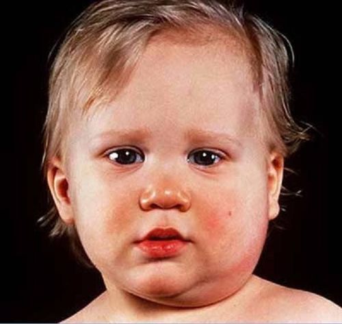 Can mumps be treated at home?