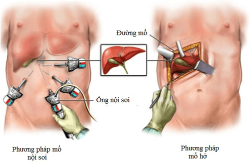 Biến chứng của phẫu thuật cắt túi mật nội soi