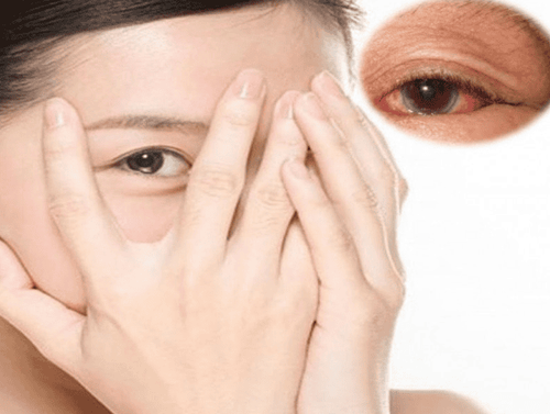 What to avoid red eye? Things need to notice