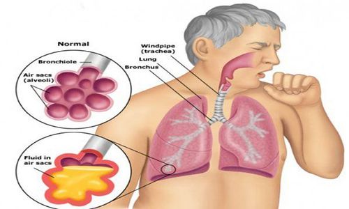 Tuberculosis: Can I get vaccinated after being vaccinated?