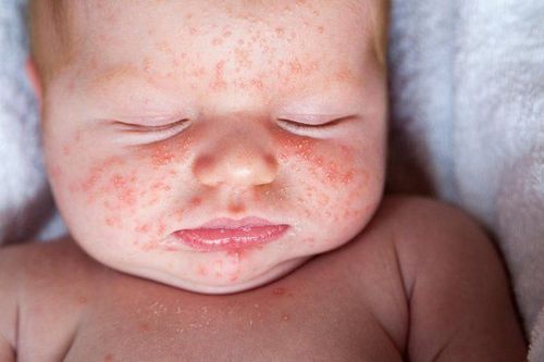 Note when treating heat rash for children