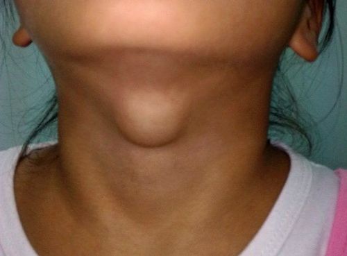 How many types of goiter are there?