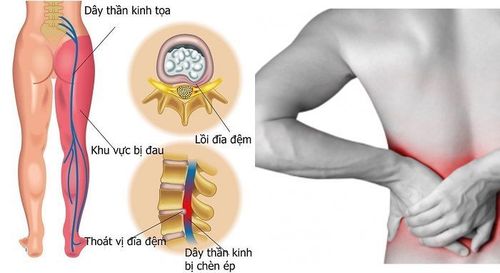 Thoát vị đĩa đệm cột sống thắt lưng có thể gây tê chân, ảnh hưởng đến thần kinh. 