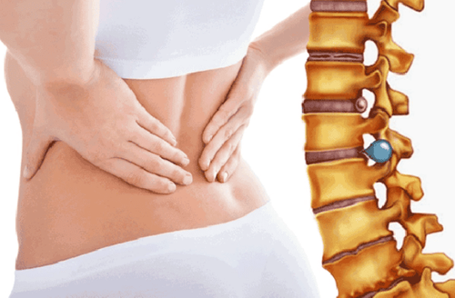 Exercise problems with people with herniated discs in the lumbar spine