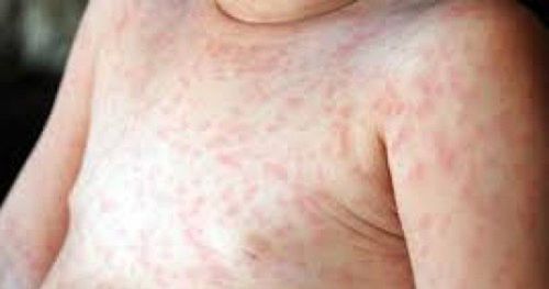 How does the measles rash grow?