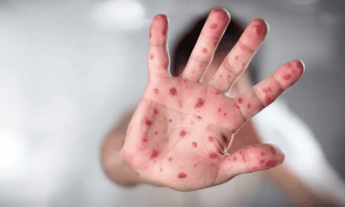 Can measles go away on its own?