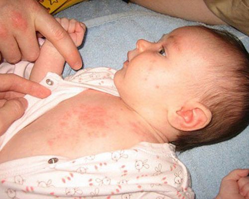 4 rules to remember when taking care of a child with measles
