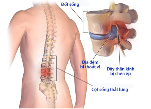 Thoát vị đĩa đệm cột sống thắt lưng là bệnh gì?