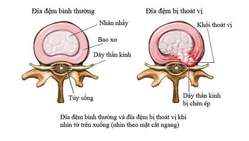 
Cấu tạo của đĩa đệm cột sống
