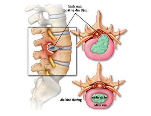 
Thoát vị đĩa đệm cột sống thắt lưng thường gặp
