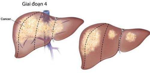 
Bệnh xơ gan F4 nếu không điều trị thì sẽ biến chứng thành ung thư gan
