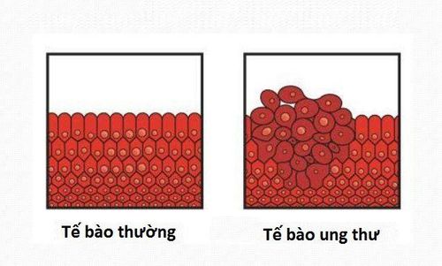 
Hình ảnh so sánh tế bào thường và tế bào ung thư
