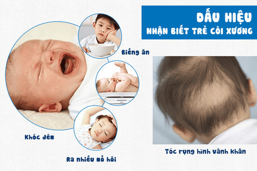 
Biểu hiện của trẻ bị còi xương
