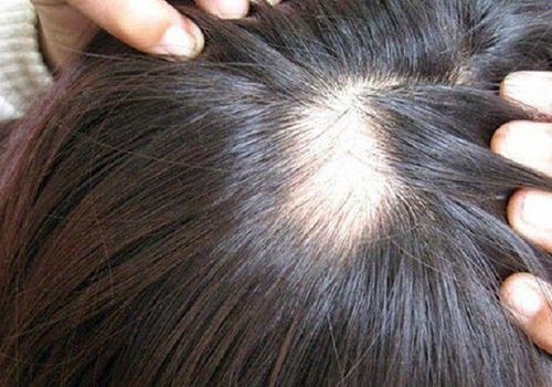 Rụng tóc và hói đầu đã điều trị những không cải thiện cần làm gì?