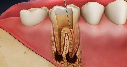 Pulpitis: When to treat?