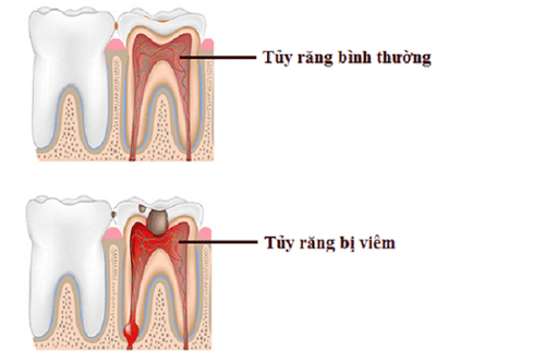 
Viêm tủy răng là một phản ứng bảo vệ của tủy răng đối với các tác nhân gây bệnh
