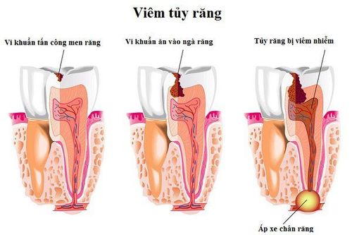 
Răng bị viêm tủy không tự lành lại được
