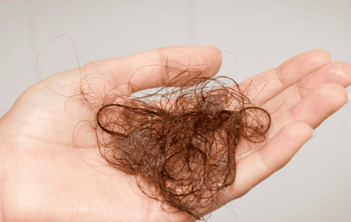 Excessive hair loss: When is the disease?