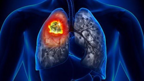 Lesson 1: Understanding lung cancer