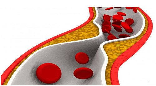 Coronary stenosis: Beware of symptoms of a heart attack