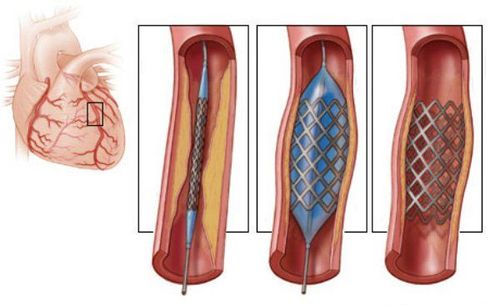 
Đặt stent mạch vành
